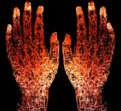 Blood vessels of human hands injected with resin