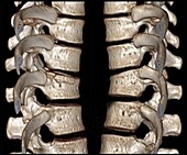 Thoracic spine vertebrae, CT scan