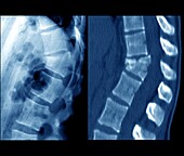 Thoracic spine fracture, X-ray and CT scan