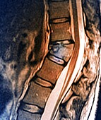 Thoracic spine fracture, MRI scan