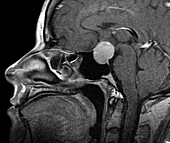 Enlarged pituitary gland, MRI scan