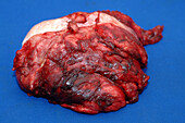 Fibrosarcoma tumour