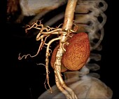 Healthy kidneys, 3D CT angiogram