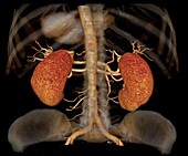 Healthy kidneys, 3D CT angiogram