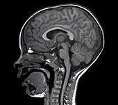 Normal brain of a child, MRI scan