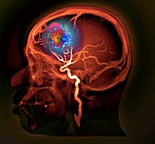 Cerebral arteriovenous malformation, CT angiogram