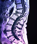 Osteoporosis, MRI scan
