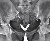 Bicornuate uterus, X-ray