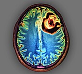 Brain abscess, MRI scan