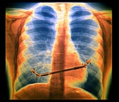 Hollowed chest treatment, X-ray