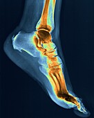Heel pain, X-ray