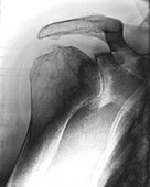 Arthritic shoulder, X-ray