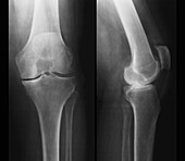 Knee pain, X-ray