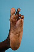 Foot of a mycetoma patient