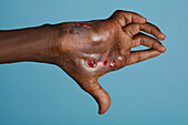 Hand of a mycetoma patient