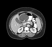 Gastric balloon, CT scan
