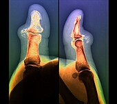 Pseudogout of a thumb, X-ray