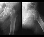 Fractured hip joint, X-ray