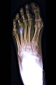 Fractured metatarsal foot bone, X-ray