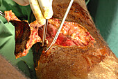 Surgeons removing necrotic skin