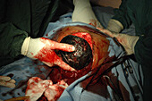 Caesarean section