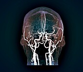 Thrombosis, MRI angiogram scan