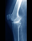 Osteoarthritis, X-ray