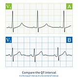 QT interval comparison, illustration