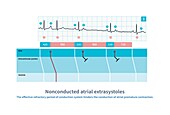 Nonconducted atrial extrasystoles, illustration