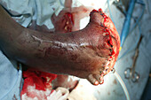 Amputation of a foot