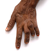 Claw hand due to leprosy