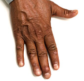 Healed ulcers on hand of leprosy patient
