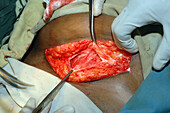 Caesarean section