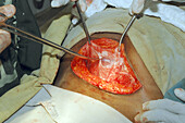 Caesarean section