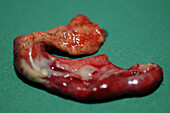 Excised appendix
