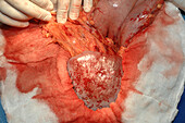 Surgeon removing an enlarged spleen