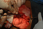 Surgeons stitching closed the abdomen