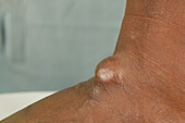 Patient with a sebaceous cyst on their foot