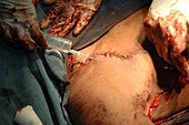 Fibrosarcoma surgery