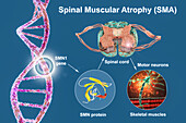 Spinal muscular atrophy, illustration
