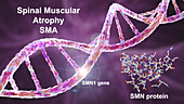 Spinal muscular atrophy, illustration