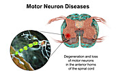 Motor neuron diseases, illustration