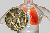 Pulmonary aspergillosis, illustration