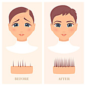 Alopecia treatment in women, illustration
