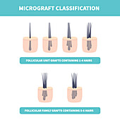 Hair micrograft classification, conceptual illustration