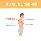 Upper crossed syndrome, conceptual illustration