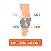 Lower crossed syndrome, conceptual illustration