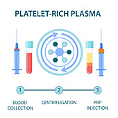 Platelet-rich plasma procedure, illustration