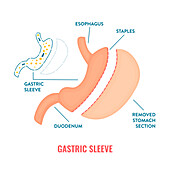 Gastric sleeve bariatric surgery, illustration