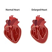 Normal and enlarged heart, illustration